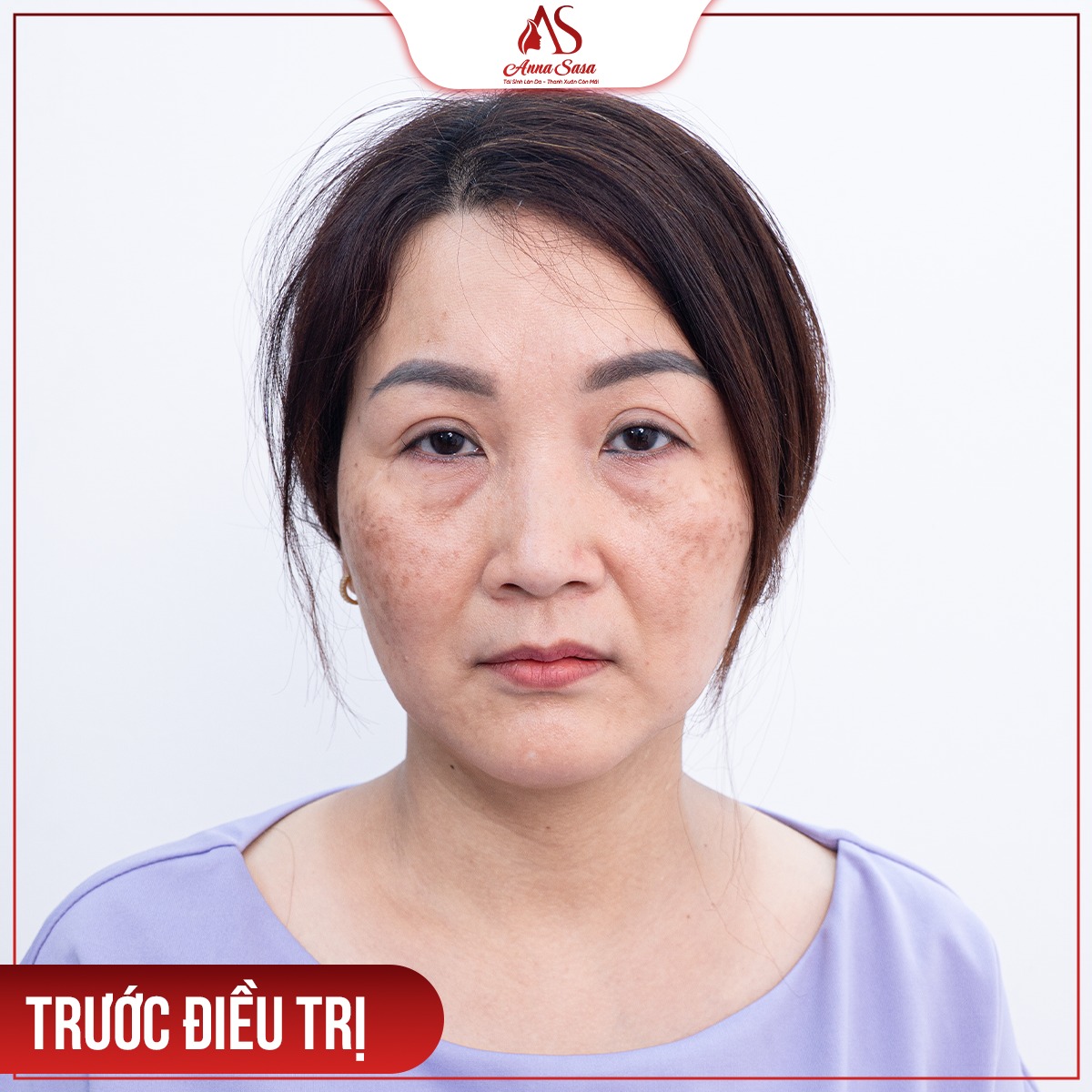 điều trị nám