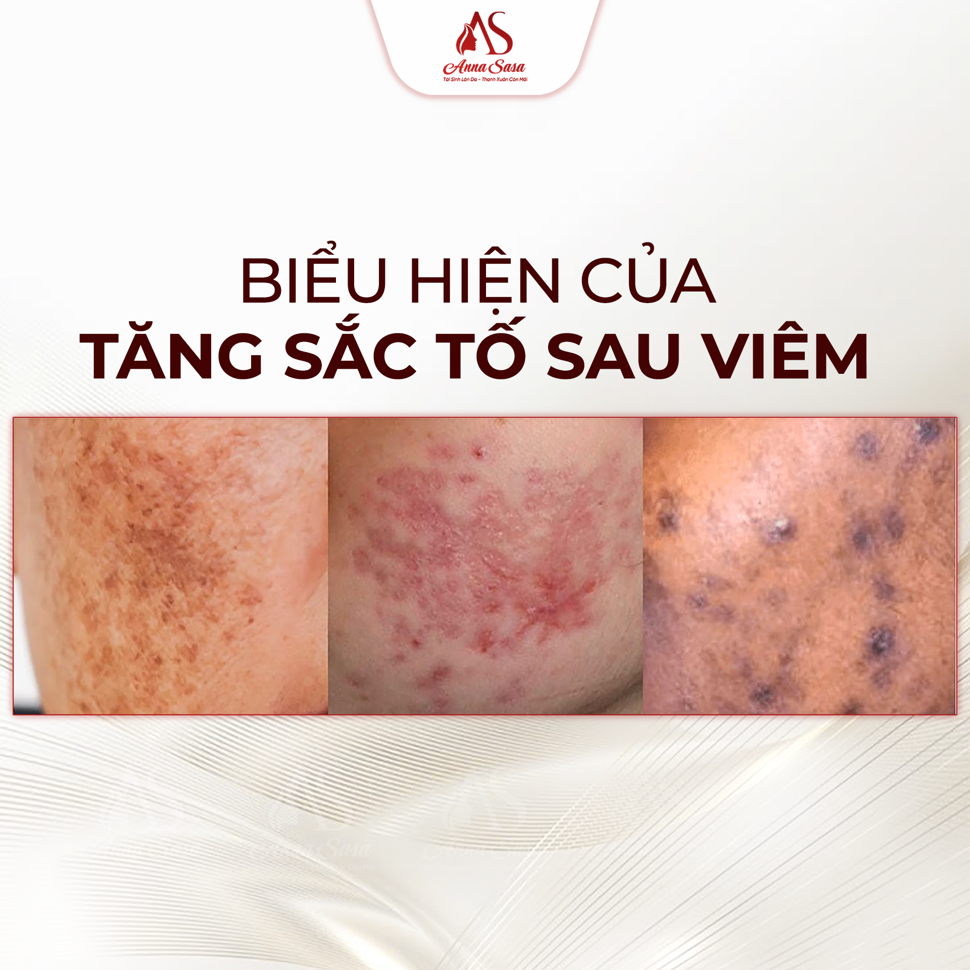 tăng sắc tố