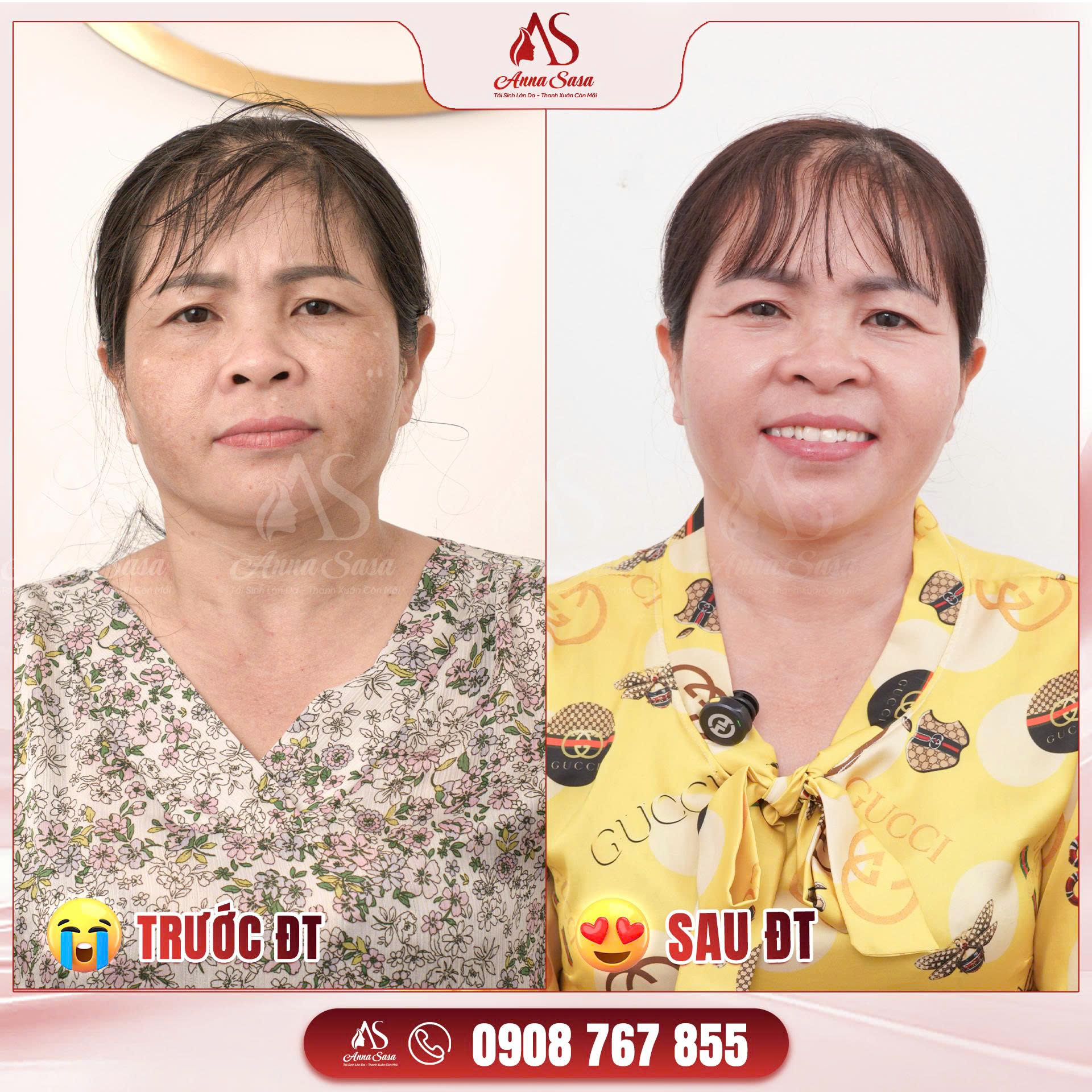 chống nắng