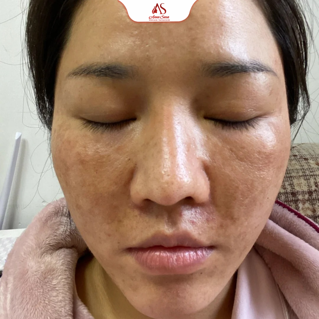 điều trị nám