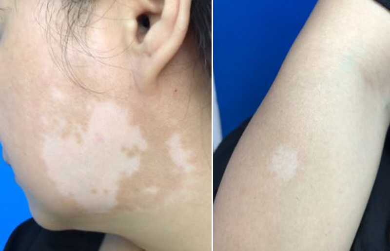 mất sắc tố