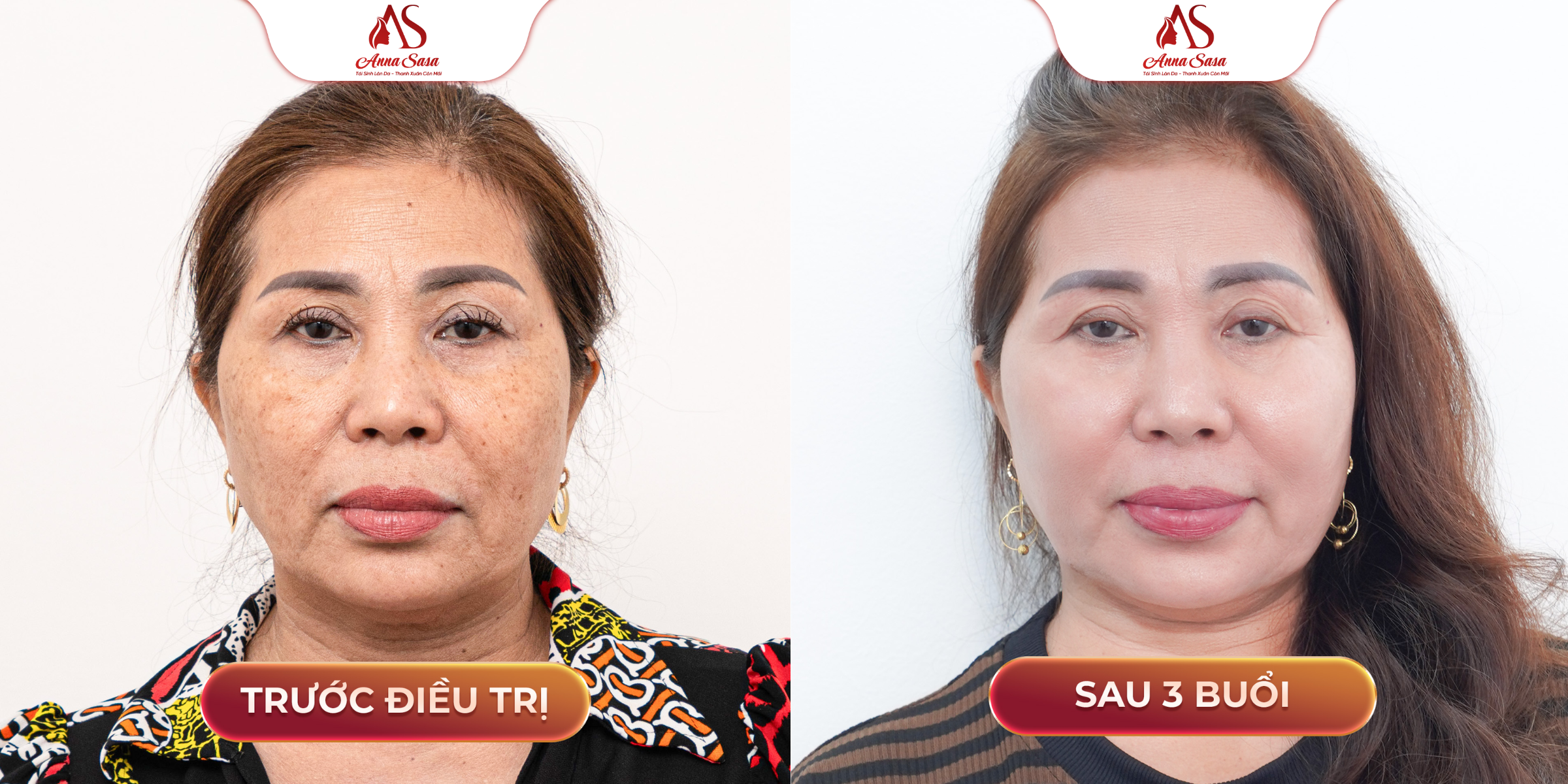 trị nám