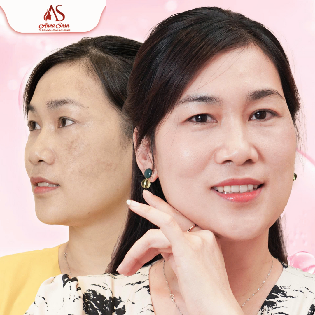 trị nám