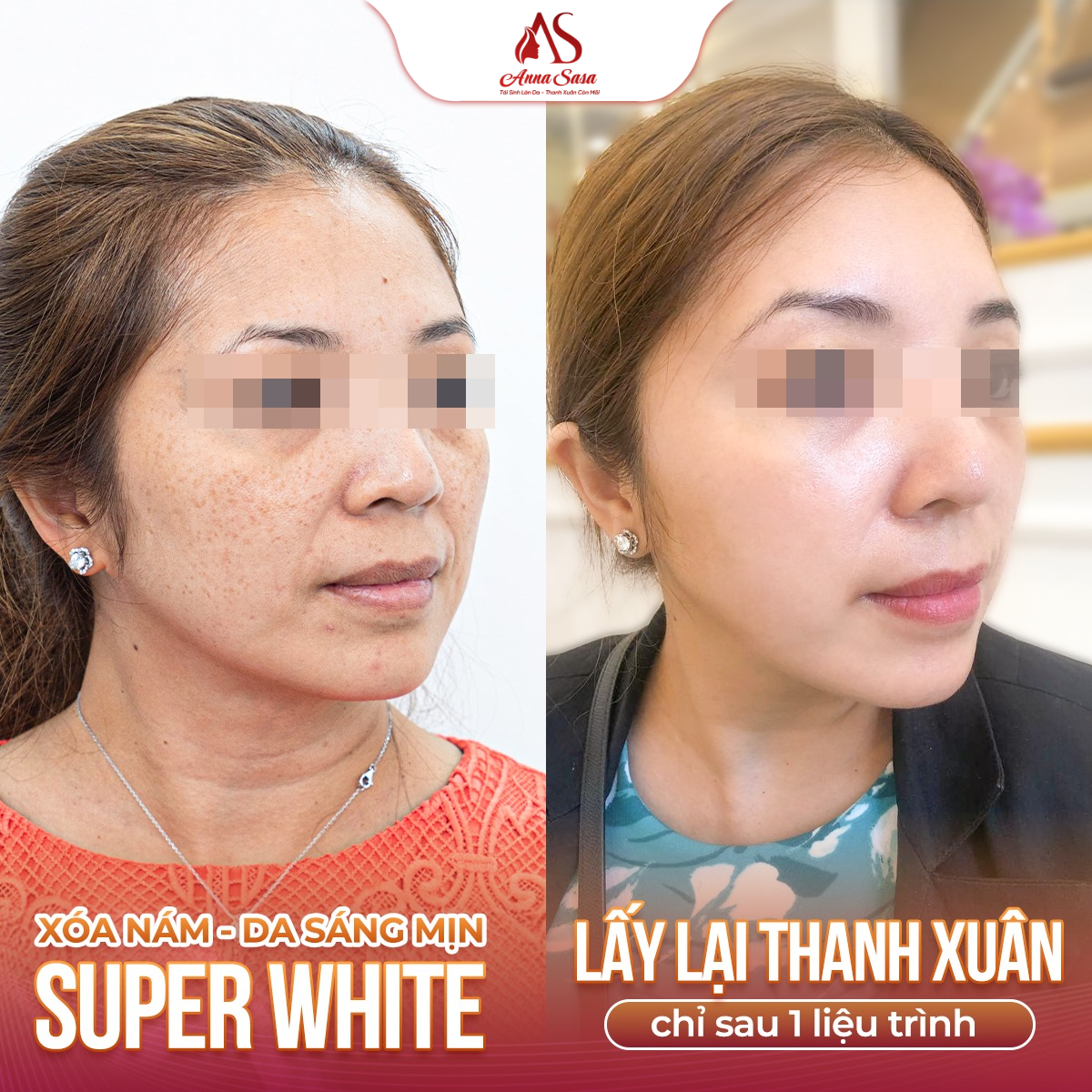 trị nám