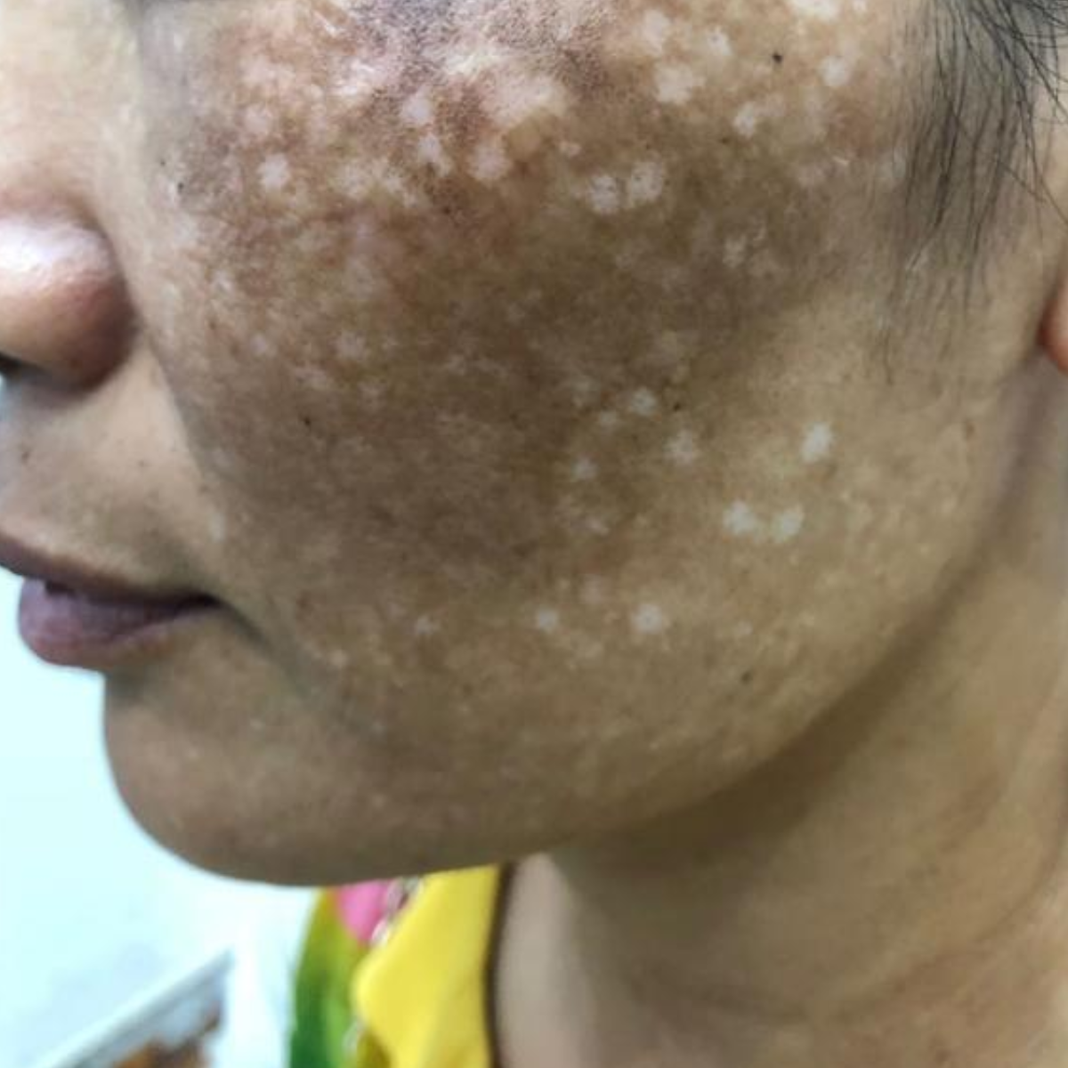 trị nám