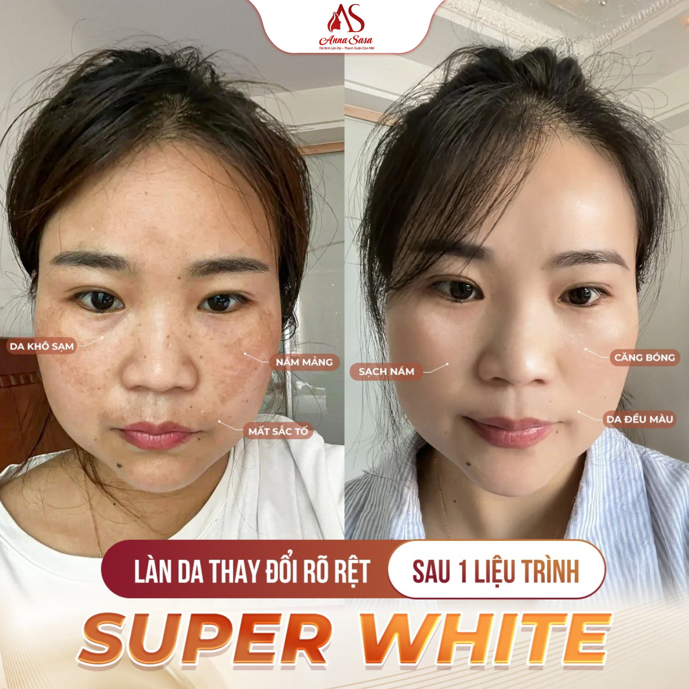 trị nám