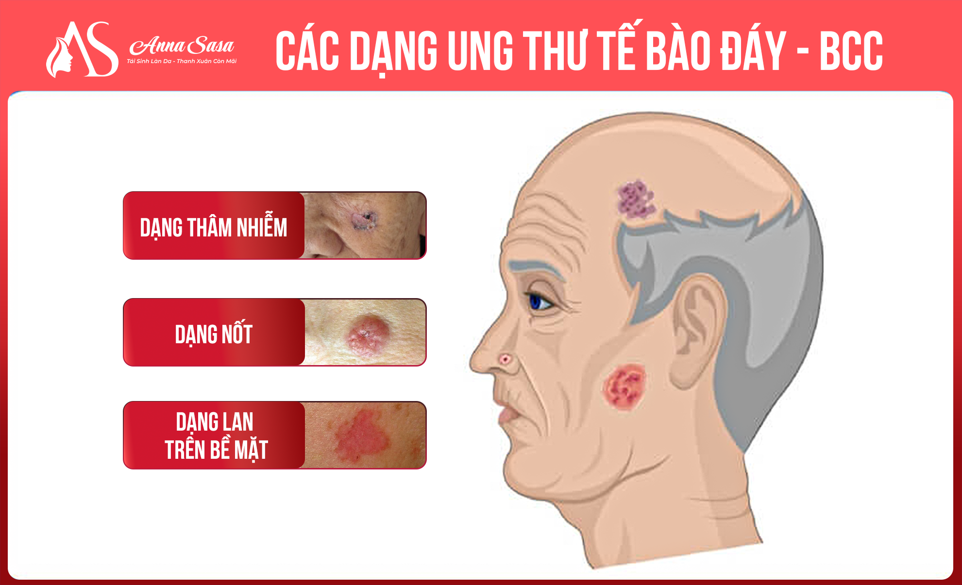 ung thư da