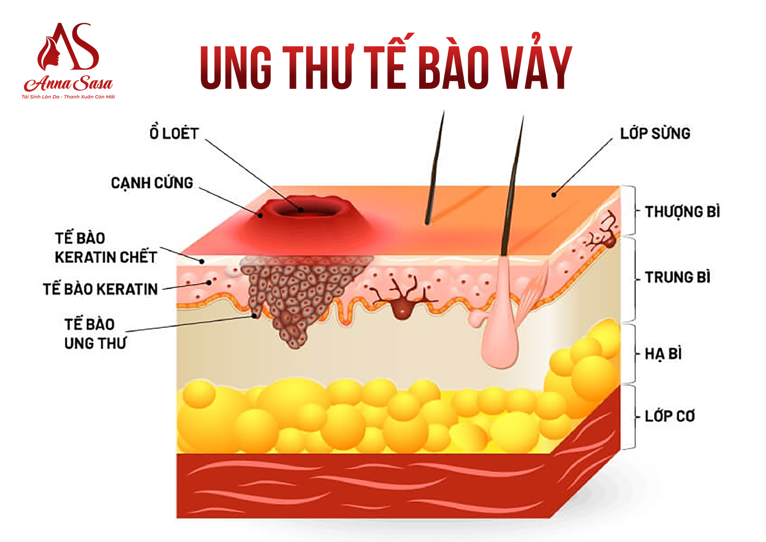 ung thư da
