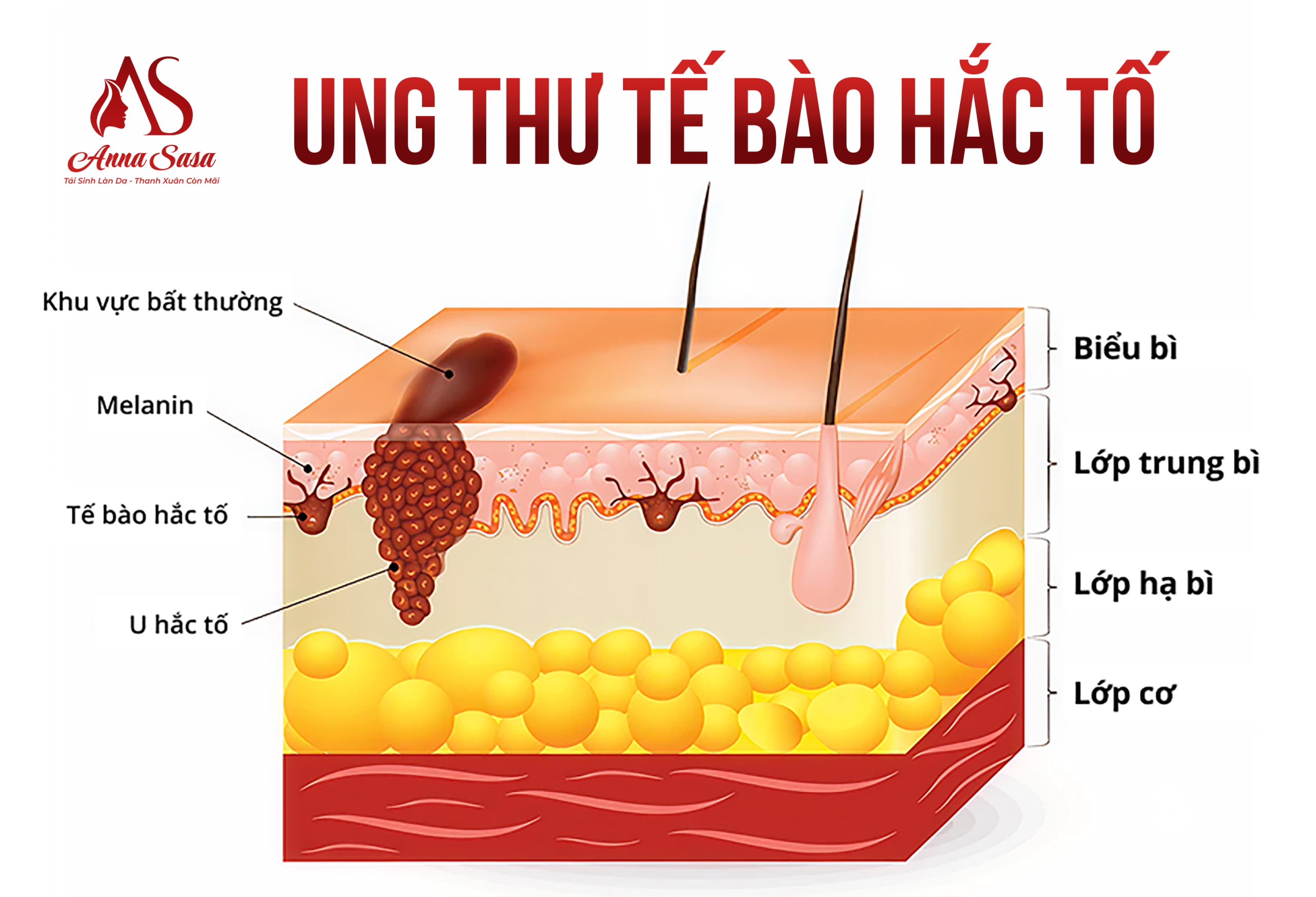 ung thư da