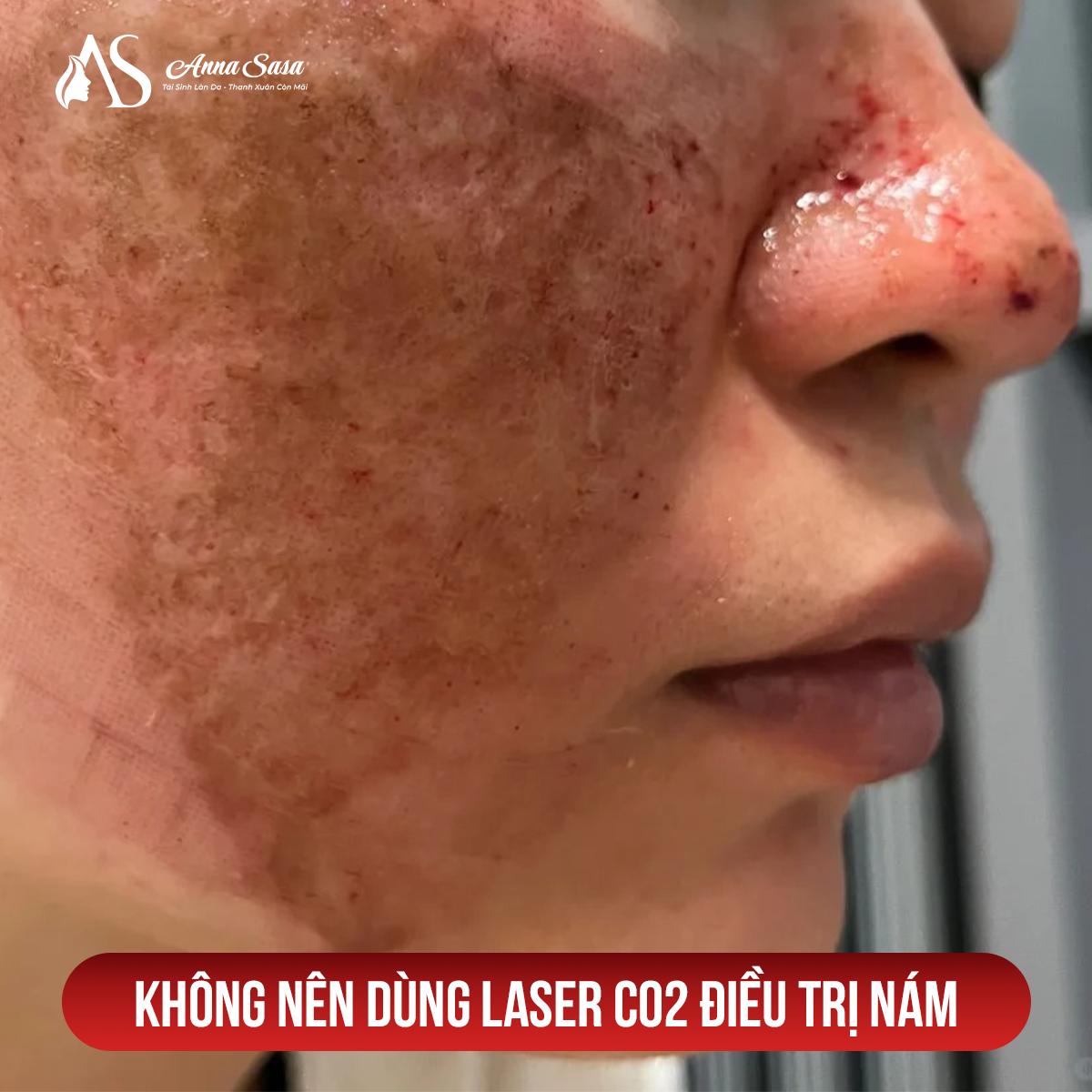 laser co2