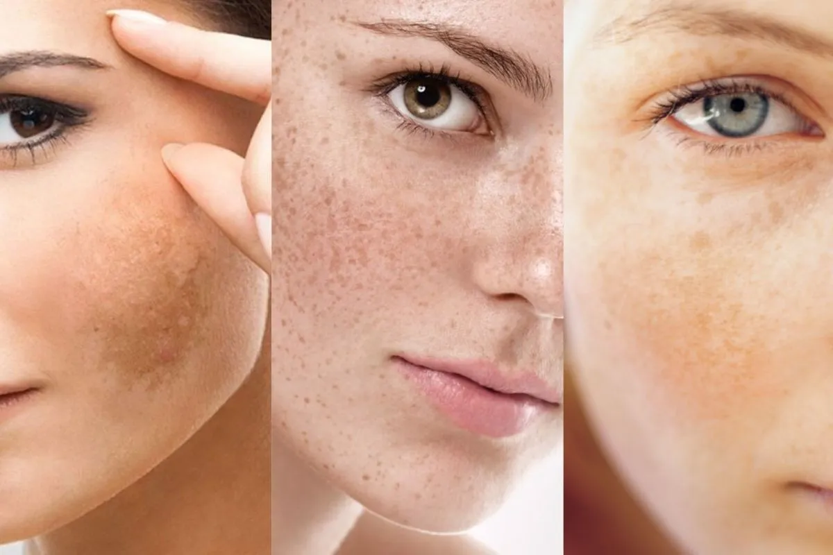 Nguyên tắc điều trị nám bền vững theo y khoa