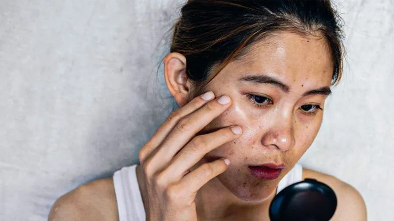 Những sai lầm khiến nám quay lại dù đã điều trị thành công